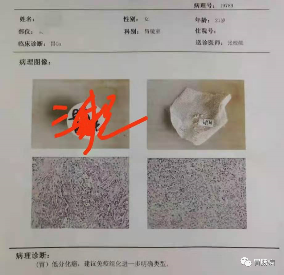 医生总结了3位年轻胃癌患者的病例：30岁不到的他们到底干啥了？